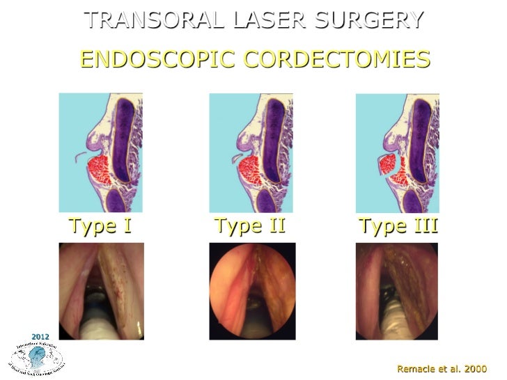Endoscopic Surgery for Laryngeal Function Preservation by P. Nicolai