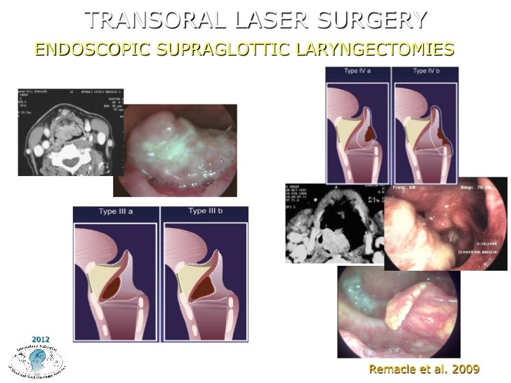 Endoscopic Surgery for Laryngeal Function Preservation by P. Nicolai