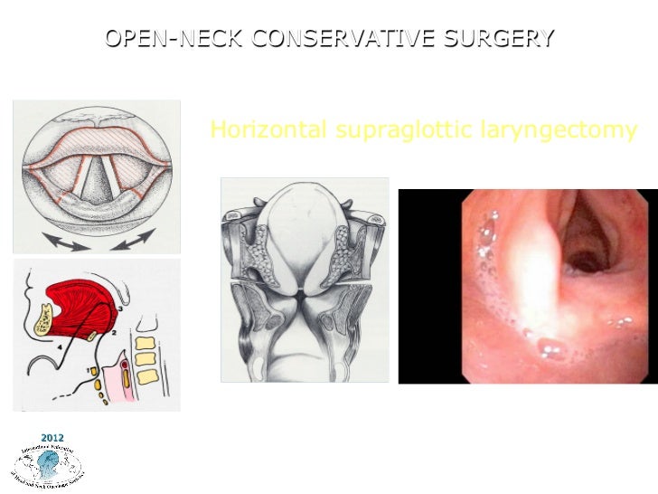 Endoscopic Surgery for Laryngeal Function Preservation by P. Nicolai