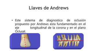 • Este sistema de diagnostico de oclusión
propuesto por Andrews esta fundamentado en el
eje longitudinal de la corona y en el plano
Oclusal.
Llaves de Andrews
 