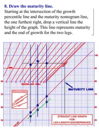 8. Draw the maturity line.
Starting at the intersection of the growth
percentile line and the maturity nomogram line,
the one furthest right, drop a vertical line the
height of the graph. This line represents maturity
and the end of growth for the two legs.
 