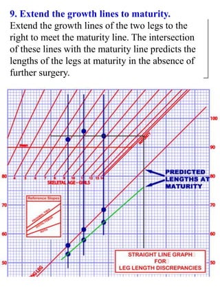 9. Extend the growth lines to maturity.
Extend the growth lines of the two legs to the
right to meet the maturity line. The intersection
of these lines with the maturity line predicts the
lengths of the legs at maturity in the absence of
further surgery.
 