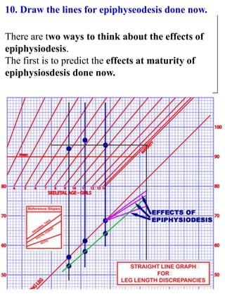 10. Draw the lines for epiphyseodesis done now.
There are two ways to think about the effects of
epiphysiodesis.
The first is to predict the effects at maturity of
epiphysiosdesis done now.
 