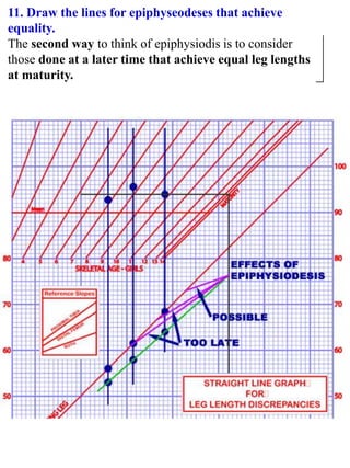 11. Draw the lines for epiphyseodeses that achieve
equality.
The second way to think of epiphysiodis is to consider
those done at a later time that achieve equal leg lengths
at maturity.
 