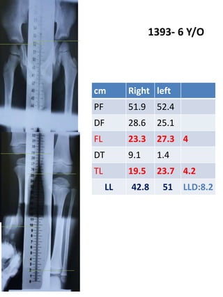 1393- 6 Y/O
cm Right left
PF 51.9 52.4
DF 28.6 25.1
FL 23.3 27.3 4
DT 9.1 1.4
TL 19.5 23.7 4.2
LL 42.8 51 LLD:8.2
 