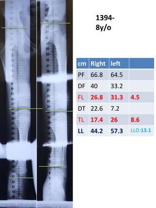 cm Right left
PF 66.8 64.5
DF 40 33.2
FL 26.8 31.3 4.5
DT 22.6 7.2
TL 17.4 26 8.6
LL 44.2 57.3 LLD:13.1
1394-
8y/o
 