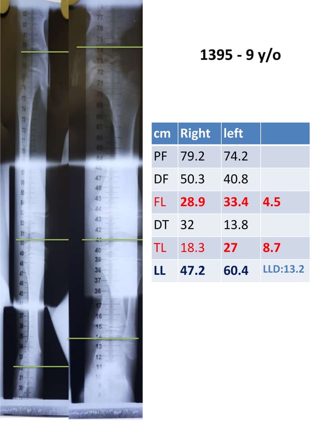 limb length discrepancy