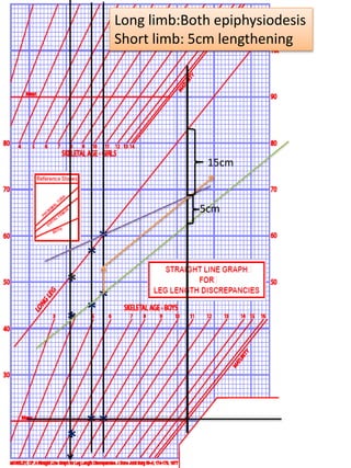 *
*
*
*
*
*
*
*
*
15cm
5cm
Long limb:Both epiphysiodesis
Short limb: 5cm lengthening
 