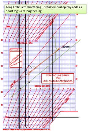 *
*
*
*
*
*
*
*
*
20cm
Long limb: 5cm shortening+ distal femoral epiphysiodesis
Short leg: 6cm lengthening
5cm
 