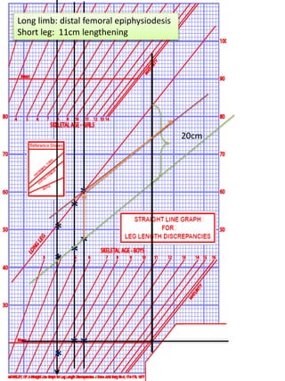 *
*
*
*
*
*
*
*
*
20cm
Long limb: distal femoral epiphysiodesis
Short leg: 11cm lengthening
 