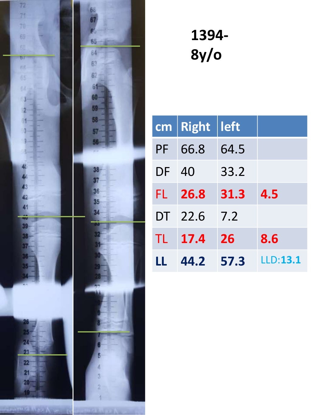 limb length discrepancy