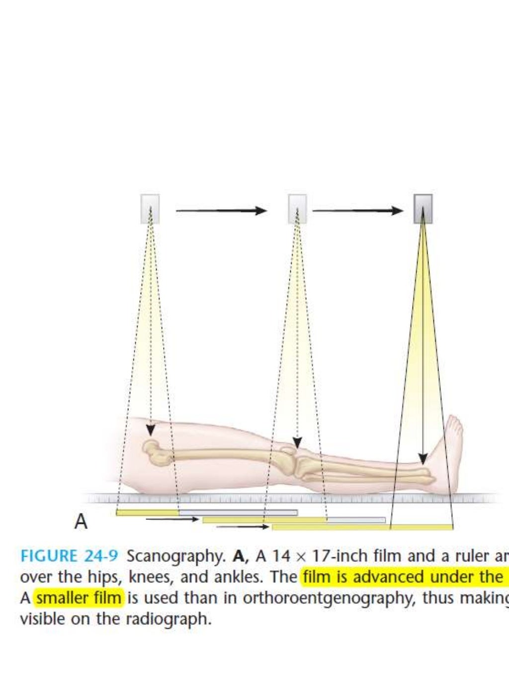 limb length discrepancy