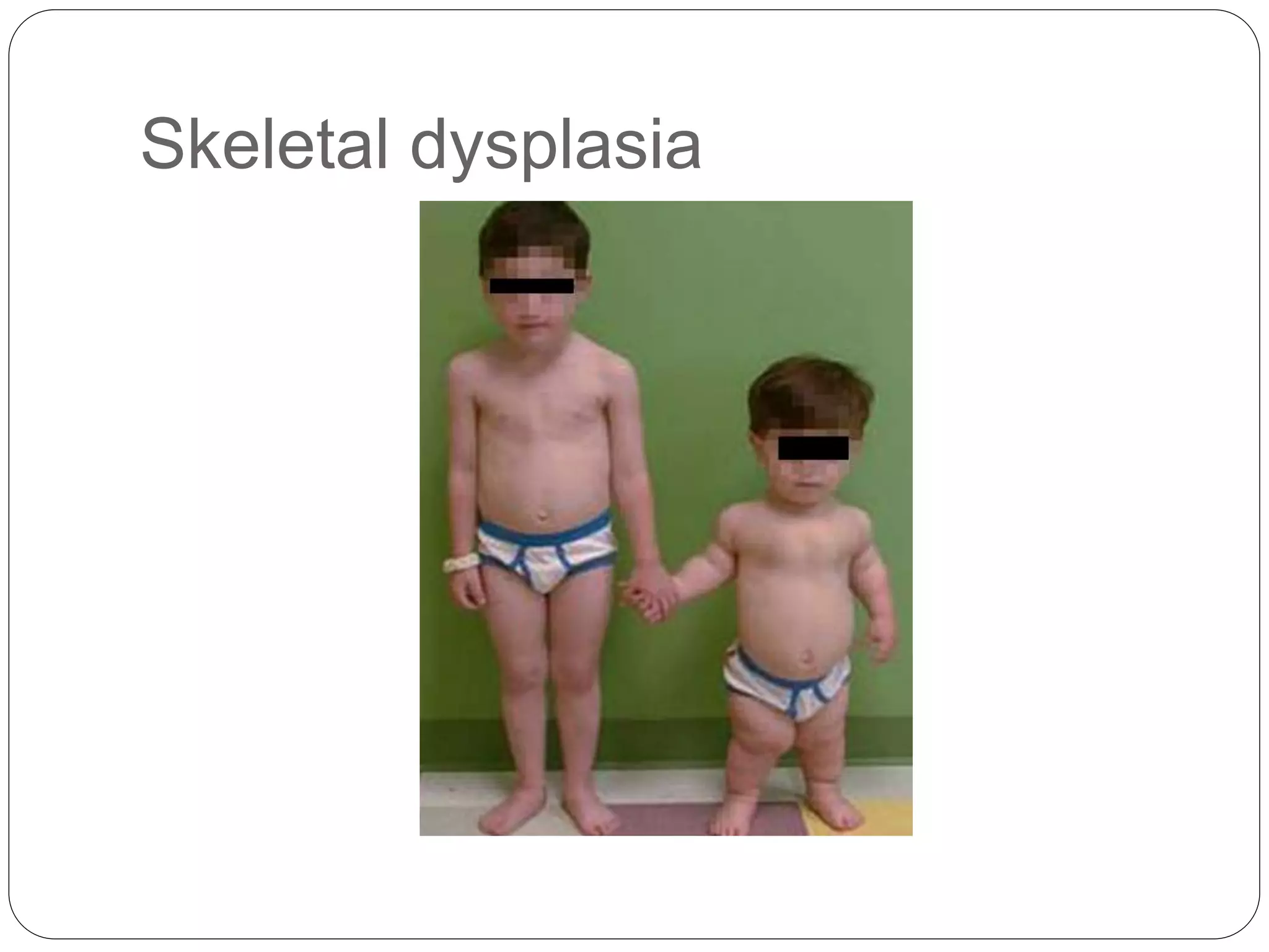 Skeletal dysplasia
 