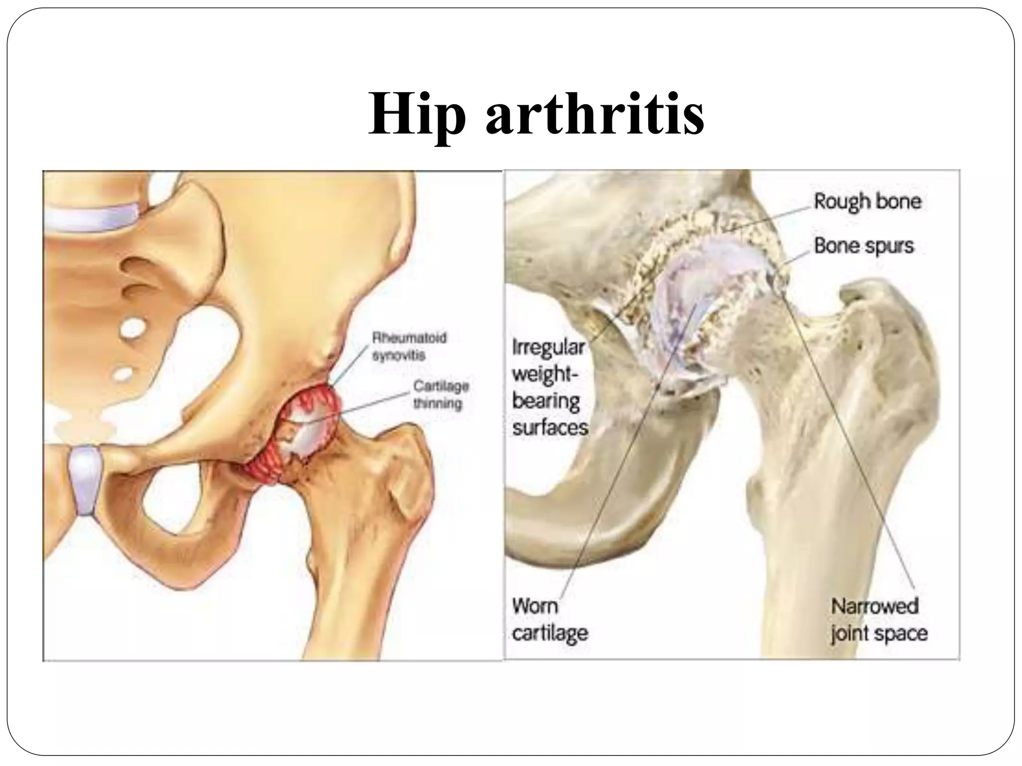 Hip arthritis
 