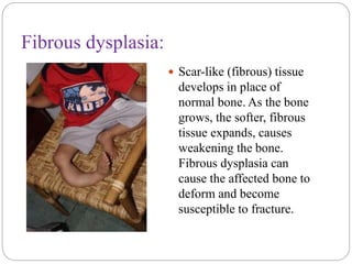 Fibrous dysplasia:
 Scar-like (fibrous) tissue
develops in place of
normal bone. As the bone
grows, the softer, fibrous
tissue expands, causes
weakening the bone.
Fibrous dysplasia can
cause the affected bone to
deform and become
susceptible to fracture.
 