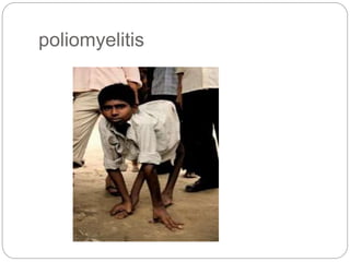 poliomyelitis
 