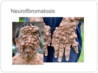 Neurofibromatosis
 