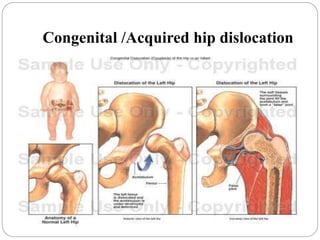 Congenital /Acquired hip dislocation
 
