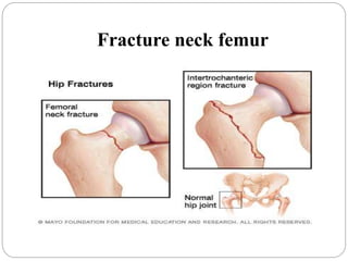 Fracture neck femur
 