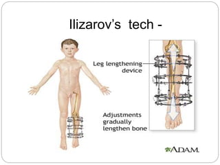 Ilizarov’s tech -
 