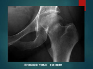 Intracapsular fracture – Subcapital
 