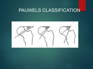 Grade 1 Grade 2 Grade 3
PAUWELS CLASSIFICATION
 