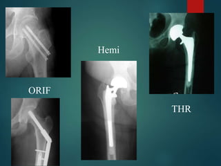 ORIF
Hemi
THR
 