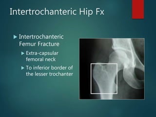 Intertrochanteric Hip Fx
 Intertrochanteric
Femur Fracture
 Extra-capsular
femoral neck
 To inferior border of
the lesser trochanter
 