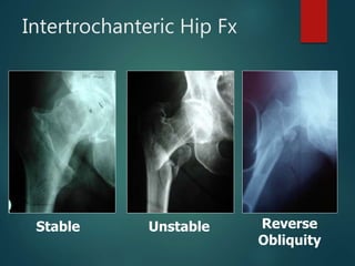 Stable Reverse
Obliquity
Unstable
Intertrochanteric Hip Fx
 