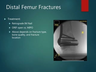 Distal Femur Fractures
 Treatment:
 Retrograde IM Nail
 ORIF open vs. MIPO
 Above depends on fracture type,
bone quality, and fracture
location
 