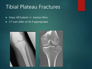 Tibial Plateau Fractures
 Xrays: AP/Lateral +/- traction films
 CT scan (after ex-fix if appropriate)
 
