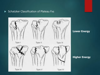  Schatzker Classification of Plateau Fxs
Lower Energy
Higher Energy
 