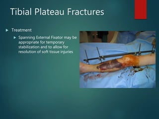 Tibial Plateau Fractures
 Treatment
 Spanning External Fixator may be
appropriate for temporary
stabilization and to allow for
resolution of soft tissue injuries
Insert blister
Pics of ex-fix here
 
