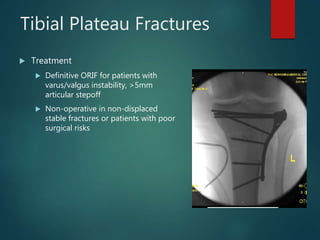 Tibial Plateau Fractures
 Treatment
 Definitive ORIF for patients with
varus/valgus instability, >5mm
articular stepoff
 Non-operative in non-displaced
stable fractures or patients with poor
surgical risks
 