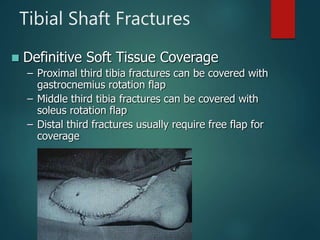Tibial Shaft Fractures
 Definitive Soft Tissue Coverage
– Proximal third tibia fractures can be covered with
gastrocnemius rotation flap
– Middle third tibia fractures can be covered with
soleus rotation flap
– Distal third fractures usually require free flap for
coverage
 