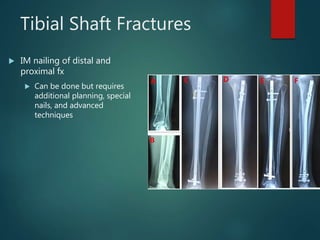 Tibial Shaft Fractures
 IM nailing of distal and
proximal fx
 Can be done but requires
additional planning, special
nails, and advanced
techniques
 