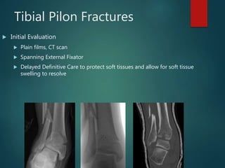 Tibial Pilon Fractures
 Initial Evaluation
 Plain films, CT scan
 Spanning External Fixator
 Delayed Definitive Care to protect soft tissues and allow for soft tissue
swelling to resolve
 