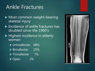 Ankle Fractures
 Most common weight-bearing
skeletal injury
 Incidence of ankle fractures has
doubled since the 1960’s
 Highest incidence in elderly
women
 Unimalleolar 68%
 Bimalleolar 25%
 Trimalleolar 7%
 Open 2%
 