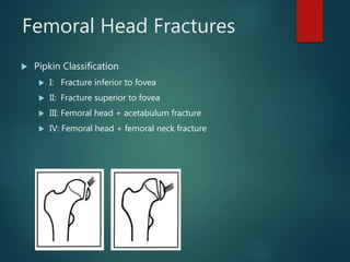 Femoral Head Fractures
 Pipkin Classification
 I: Fracture inferior to fovea
 II: Fracture superior to fovea
 III: Femoral head + acetabulum fracture
 IV: Femoral head + femoral neck fracture
 