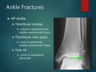 Ankle Fractures
 AP Ankle
 Tibiofibular overlap
 <10mm is abnormal and
implies syndesmotic injury
 Tibiofibular clear space
 >5mm is abnormal -
implies syndesmotic injury
 Talar tilt
 >2mm is considered
abnormal
 