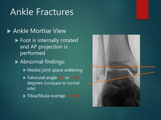 Ankle Fractures
 Ankle Mortise View
 Foot is internally rotated
and AP projection is
performed
 Abnormal findings:
 Medial joint space widening
 Talocural angle <8 or >15
degrees (compare to normal
side)
 Tibia/fibula overlap <1mm
 