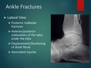 Ankle Fractures
 Lateral View
 Posterior malleolar
fractures
 Anterior/posterior
subluxation of the talus
under the tibia
 Displacement/Shortening
of distal fibula
 Associated injuries
 