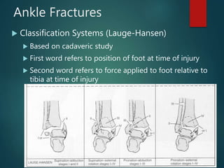 Ankle Fractures
 Classification Systems (Lauge-Hansen)
 Based on cadaveric study
 First word refers to position of foot at time of injury
 Second word refers to force applied to foot relative to
tibia at time of injury
 