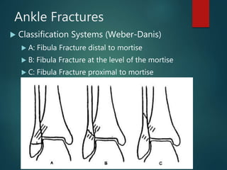 Ankle Fractures
 Classification Systems (Weber-Danis)
 A: Fibula Fracture distal to mortise
 B: Fibula Fracture at the level of the mortise
 C: Fibula Fracture proximal to mortise
 