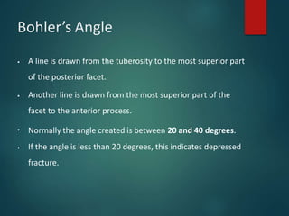 Bohler’s Angle
▪ A line is drawn from the tuberosity to the most superior part
of the posterior facet.
▪ Another line is drawn from the most superior part of the
facet to the anterior process.
Normally the angle created is between 20 and 40 degrees.
▪
▪ If the angle is less than 20 degrees, this indicates depressed
fracture.
 