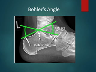 Bohler’s Angle
 