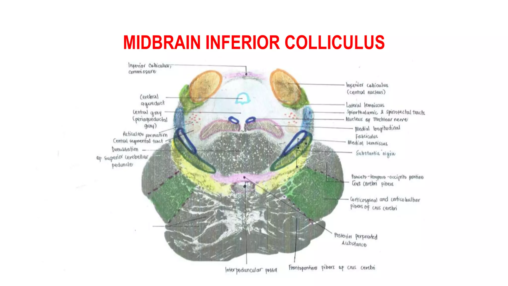 MIDBRAIN INFERIOR COLLICULUS
 