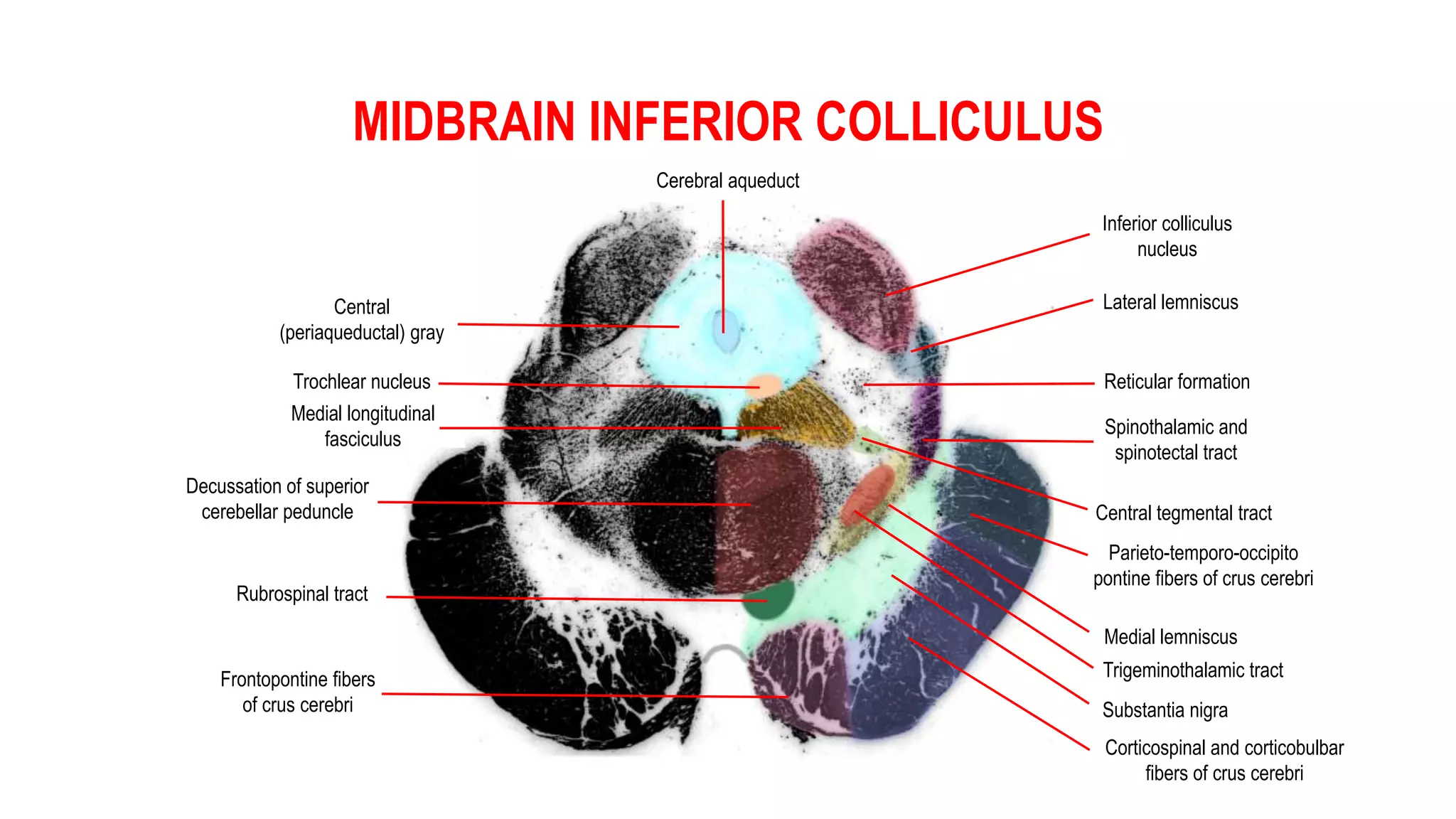 MIDBRAIN INFERIOR COLLICULUS
Cerebral aqueduct
Central
(periaqueductal) gray
Lateral lemniscus
Trochlear nucleus
Inferior colliculus
nucleus
Reticular formation
Spinothalamic and
spinotectal tract
Central tegmental tract
Medial longitudinal
fasciculus
Parieto-temporo-occipito
pontine fibers of crus cerebri
Decussation of superior
cerebellar peduncle
Rubrospinal tract
Medial lemniscus
Trigeminothalamic tract
Substantia nigra
Corticospinal and corticobulbar
fibers of crus cerebri
Frontopontine fibers
of crus cerebri
 