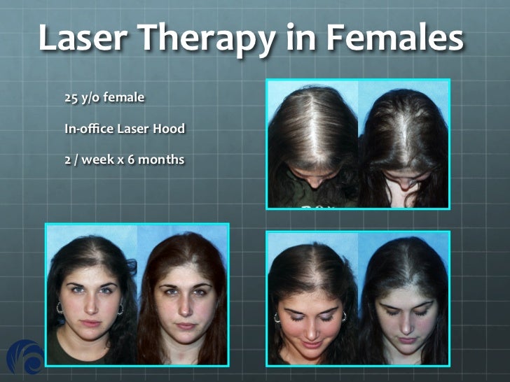 androgenetic alopecia under fontanacountryinn com androgenetic alopecia