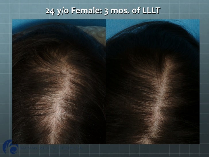 androgenetic alopecia under fontanacountryinn com androgenetic alopecia